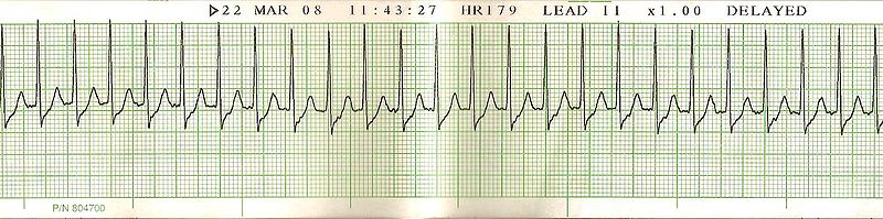 Lmh Ed Technician Cardiac Rhythm Quiz - Quiz